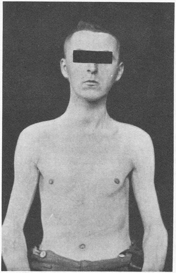 FIGURE 4 Kretschmer’s asthenic type, described as “schizoid psychopath” (Kretschmer 1925, pl. 1