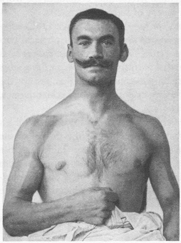 FIGURE 6 Kretschmer’s athletic type, identified with “schizophrenia” (Kretschmer 1925, pl. 3)